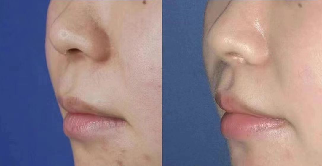 技術(shù)貼膚不繃臉，自然又顯年輕