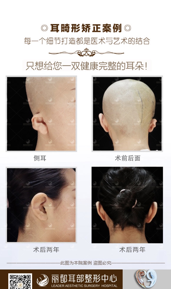 太原美媛薈醫(yī)療美容醫(yī)院 - 超聲波射頻拉皮特色