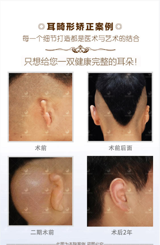 太原華美整形美容醫(yī)院 - 數(shù)字化拉皮精細(xì)體驗(yàn)