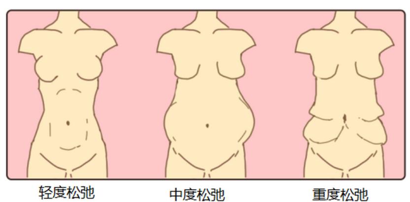 三. 劉沙醫(yī)生腹壁整形到底怎么約更穩(wěn)妥？m.sorencai.cn