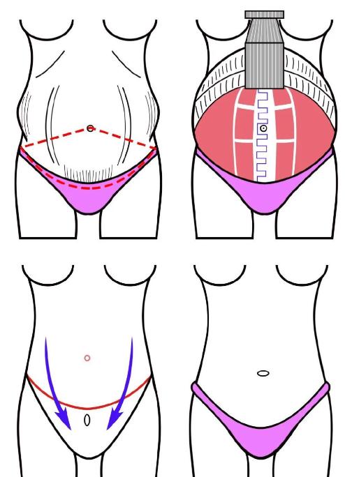 三、劉沙腹壁整形手術(shù)價(jià)格避坑與常見(jiàn)問(wèn)題解答