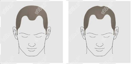 發(fā)際線后移類型 發(fā)際線后移類型