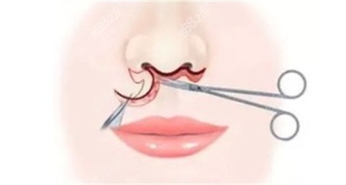 人中縮短 人中縮短