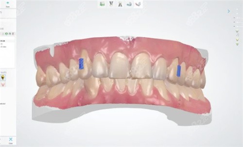 牙齒矯正方案設計中 牙齒矯正方案設計中