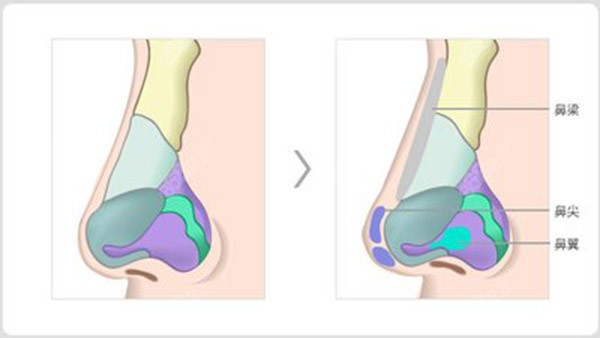 成都隆鼻專家前十名揭秘！鄧東偉“8C骨雕鼻”，初鼻整形3.8萬起！ 
