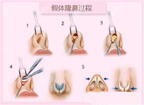 成都周維做鼻子怎么樣？他憑“原生力美學(xué)”+細(xì)節(jié)把控，術(shù)后宛若媽生鼻，