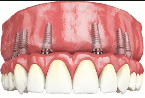 全口種植牙動畫示意圖