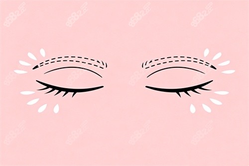 劉志剛眼修復(fù)做的真的好？ 2026劉志剛院長(zhǎng)重瞼修復(fù)風(fēng)格及術(shù)后真實(shí)口碑