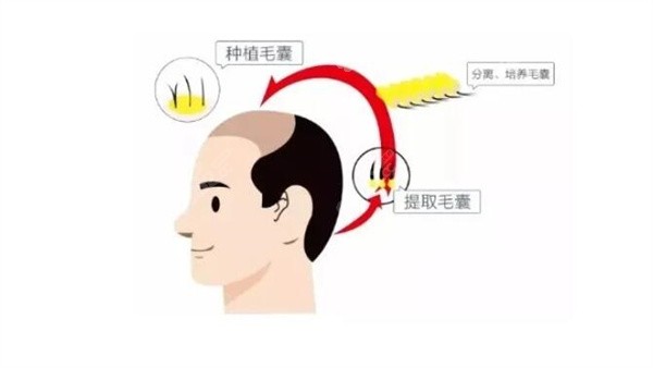 襄陽禿頂植發(fā)醫(yī)院排名