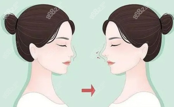 成都鼻綜合出名的醫(yī)生有哪些？媽生鼻/軟糖鼻/榫卯支架大佬集結(jié)，審美技