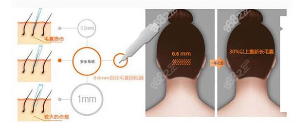 襄陽禿頂植發(fā)醫(yī)院排名：襄陽市中心醫(yī)院、襄陽市第一人民醫(yī)院、襄陽市中