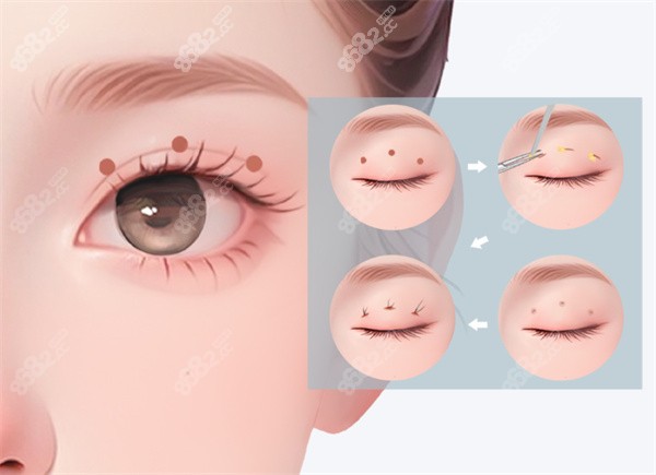 雙眼皮整形卡通圖片