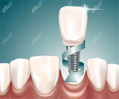 2026都勻植德口腔價格表詳解:種牙5800起|牙齒矯正9800起
