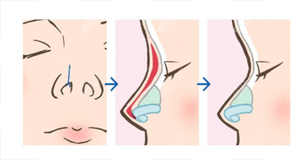 成都鼻綜合出名的醫(yī)生 成都鼻綜合出名的醫(yī)生