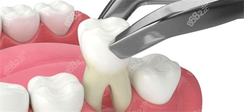 拔掉生長歪斜的牙齒 拔掉生長歪斜的牙齒