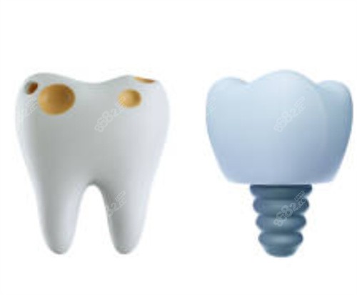 壞的牙齒和種植牙 壞的牙齒和種植牙