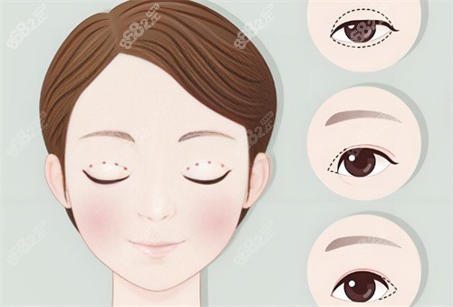 雙眼皮卡通動(dòng)畫(huà)圖 雙眼皮卡通動(dòng)畫(huà)圖