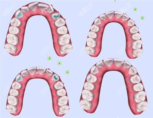 牙齒矯正模擬結果對比 牙齒矯正模擬結果對比