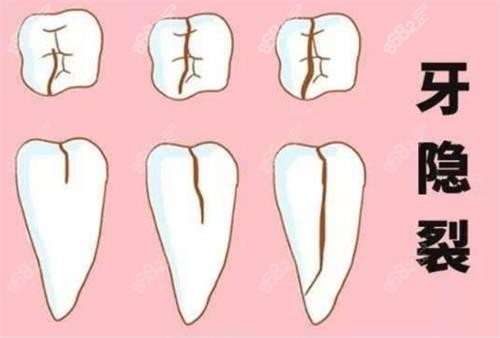 牙齒裂紋的程度