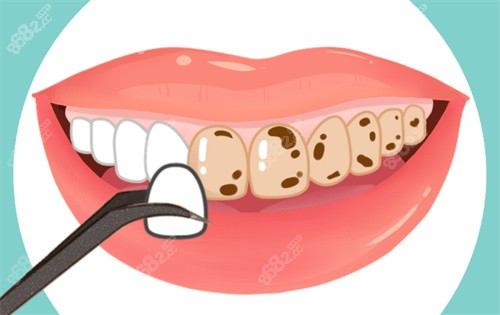 牙齒貼面動畫圖