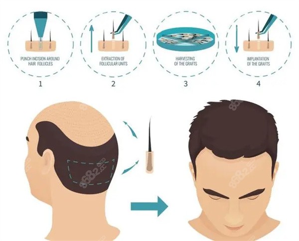 襄陽禿頂植發(fā)醫(yī)院排名