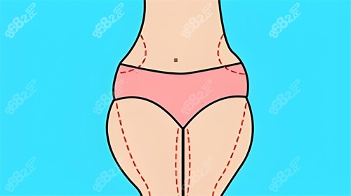 腿部吸脂手術(shù)吸脂部位動(dòng)畫圖 腿部吸脂手術(shù)吸脂部位動(dòng)畫圖