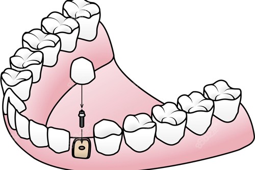 種植牙安裝牙冠卡通圖