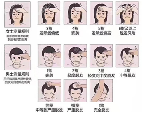 發(fā)際線測(cè)量規(guī)范 發(fā)際線測(cè)量規(guī)范