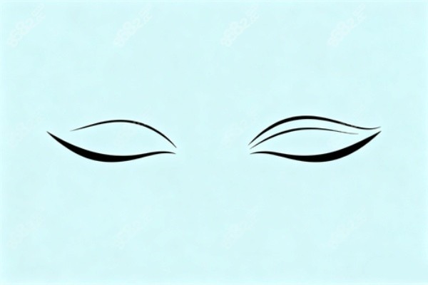 割雙眼皮展示圖一覽