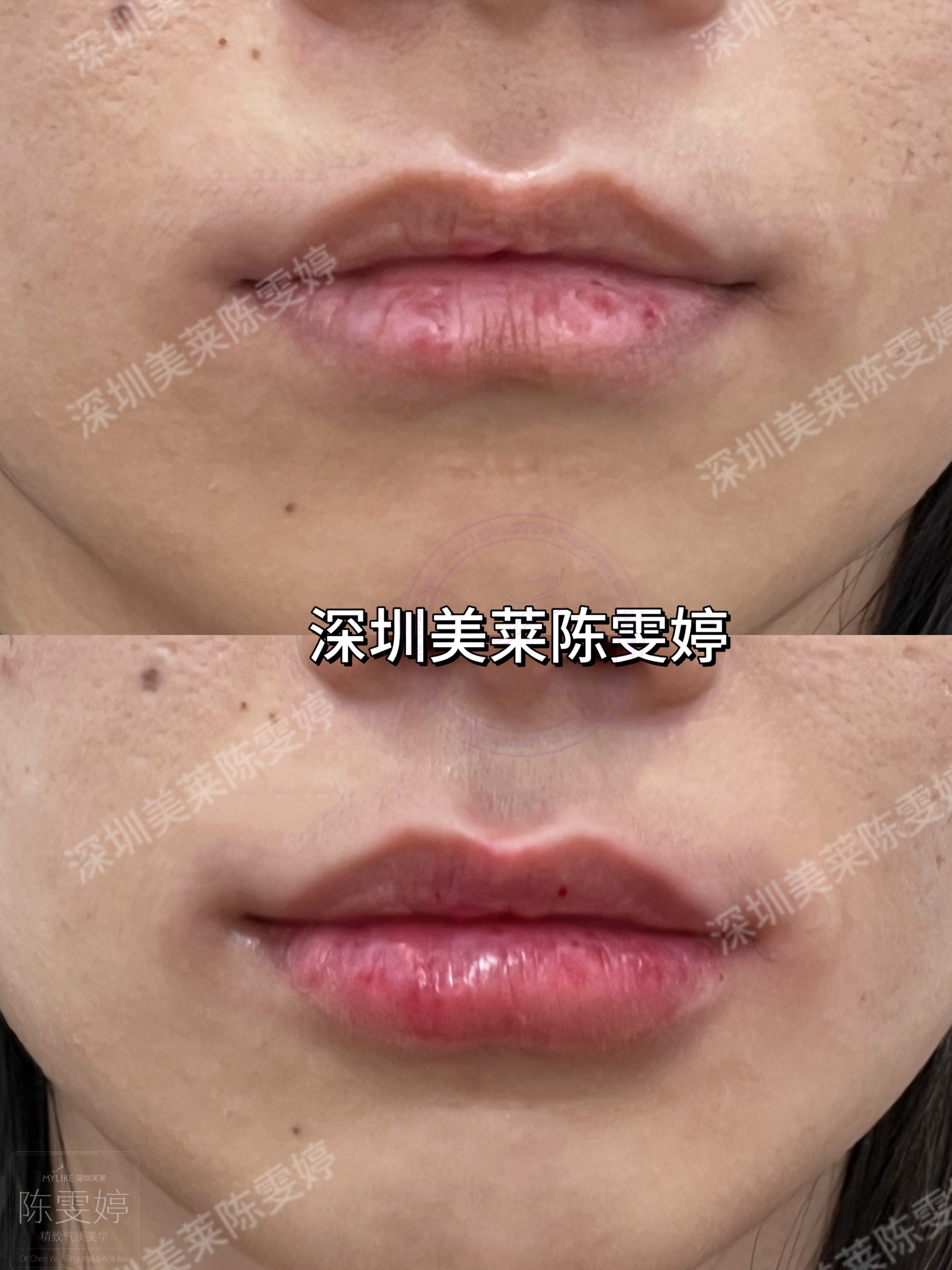 四、深圳美萊孫婧隆胸價格參考：透明且性價比高