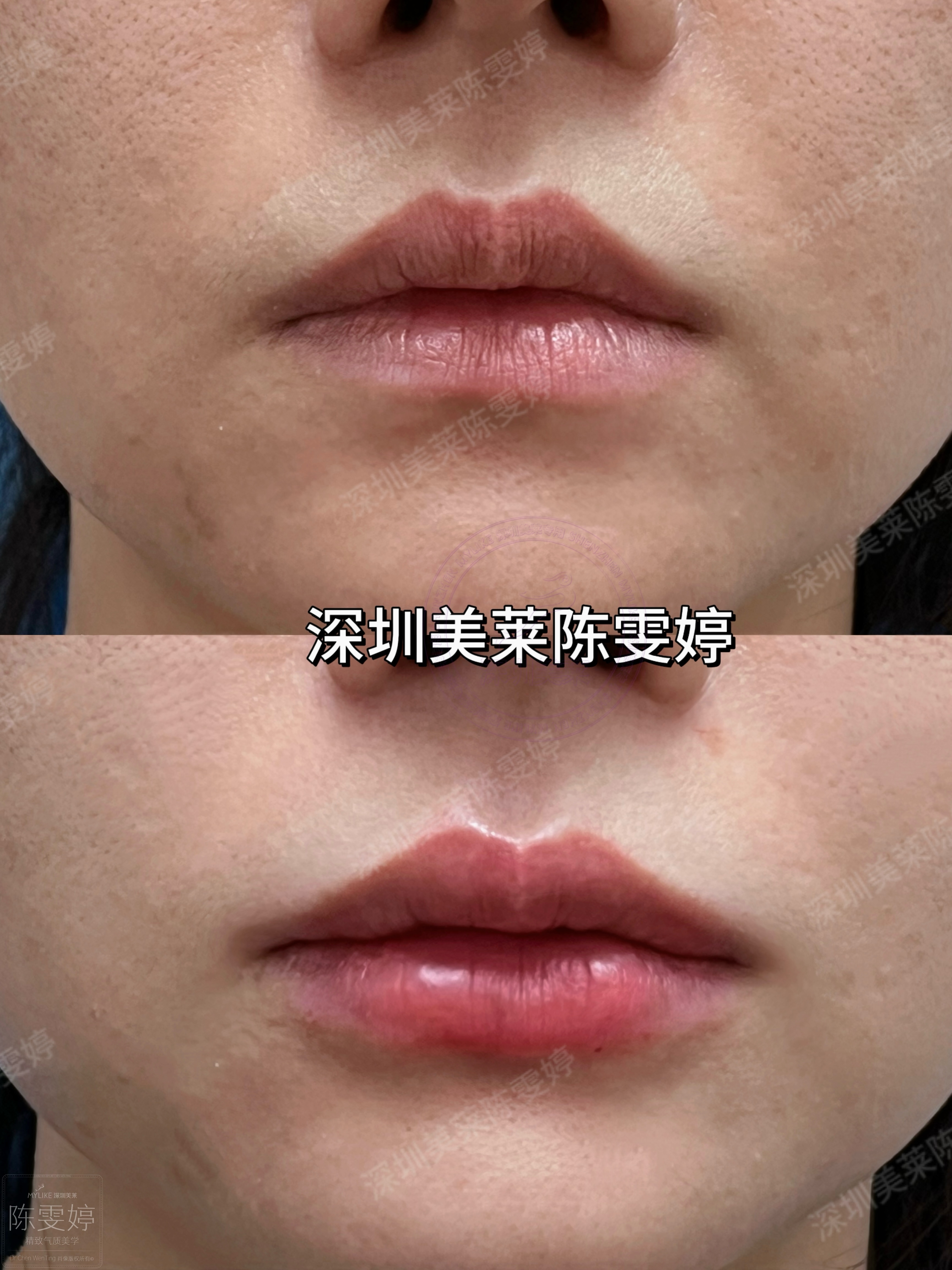 五、真實口碑：自然、隱痕、修復快