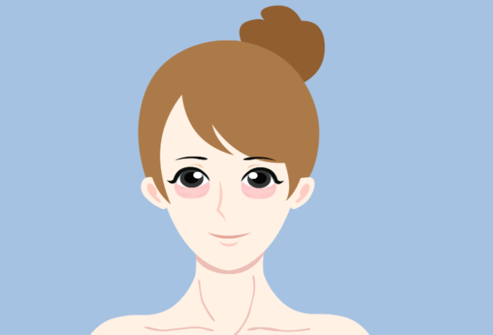 上海路亮做臥蠶留疤嗎？我對比了3位醫(yī)生，路亮的手術(shù)痕跡比較淡