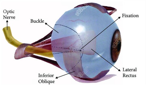 后鞏膜加固術(shù)動(dòng)畫圖 后鞏膜加固術(shù)動(dòng)畫圖