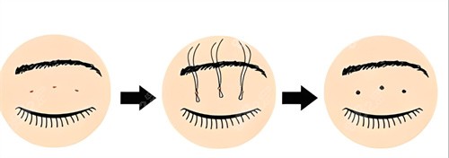 想找李紹思醫(yī)生做雙眼皮？技術(shù)優(yōu)勢、手術(shù)特色、真實網(wǎng)友分享全解析