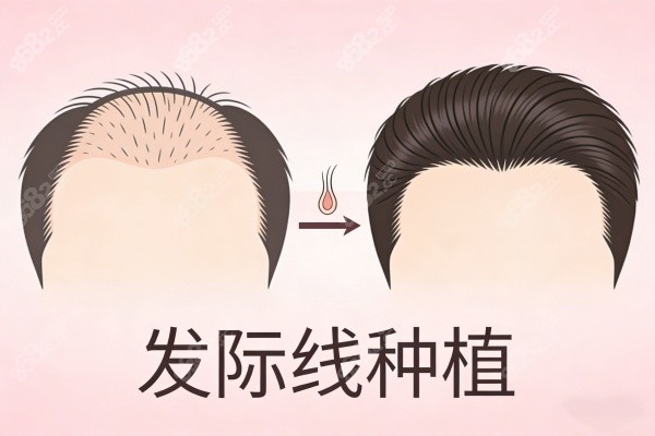 發(fā)際線種植前后對比圖展示 發(fā)際線種植前后對比圖展示