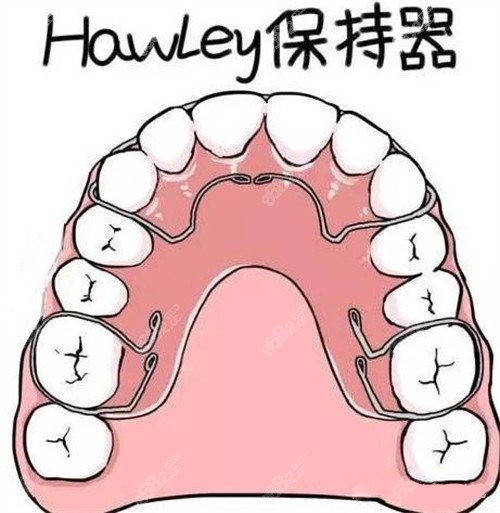 牙齒矯正Hawley哈雷保持器