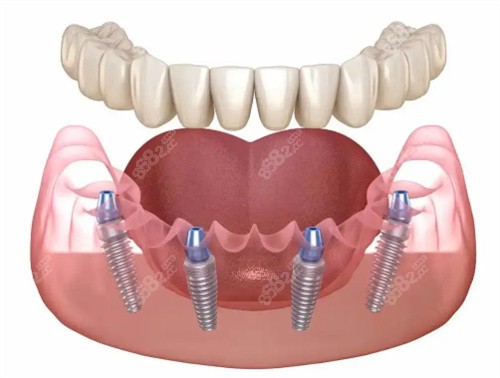 種植牙展示卡通圖 種植牙展示卡通圖