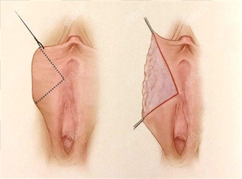 女性私密手術(shù)動(dòng)畫展示