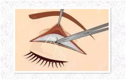 雙眼皮肉條修復(fù)術(shù) 雙眼皮肉條修復(fù)術(shù)