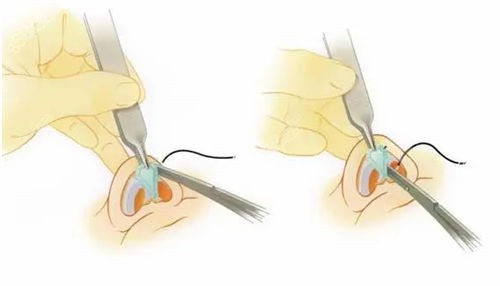 隆鼻手術(shù)鼻頭過程展示圖