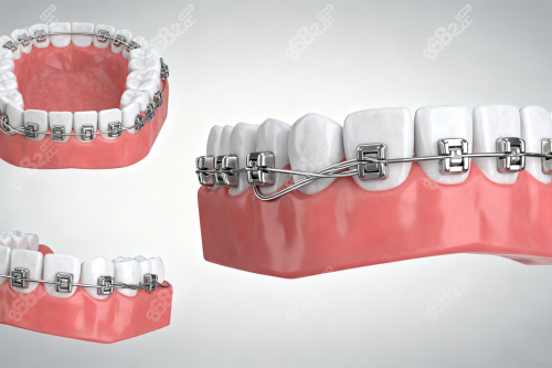 牙齒矯正模型圖片一覽 牙齒矯正模型圖片一覽