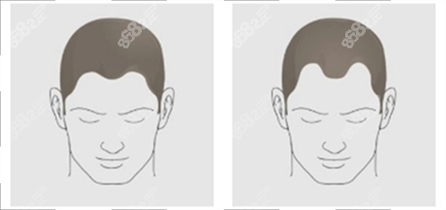 發(fā)際線對比 發(fā)際線對比