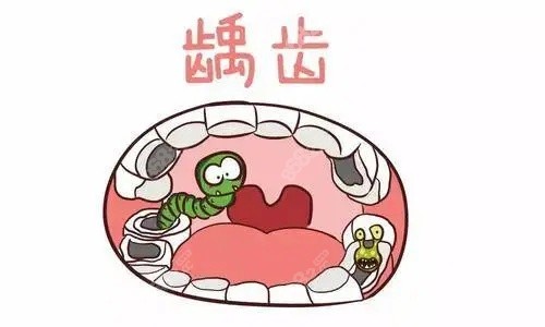 牙齒齲齒示意圖