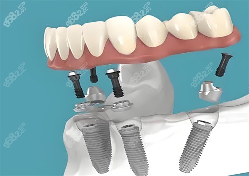 溫州鹿城種植牙現(xiàn)在多少錢？韓國(guó)進(jìn)口3980元起/半口3.5萬+全分享