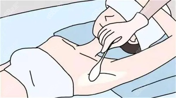 顧建成微波腋臭治療費(fèi)用3萬左右