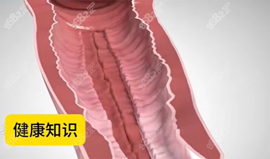 陰道緊縮針原理圖片