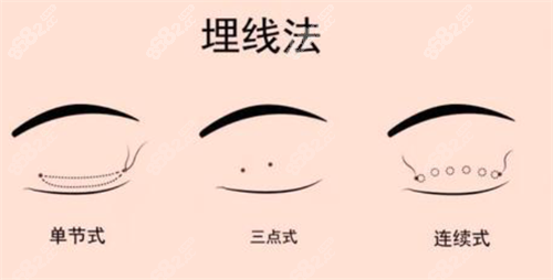 埋線雙眼皮經(jīng)過 埋線雙眼皮經(jīng)過