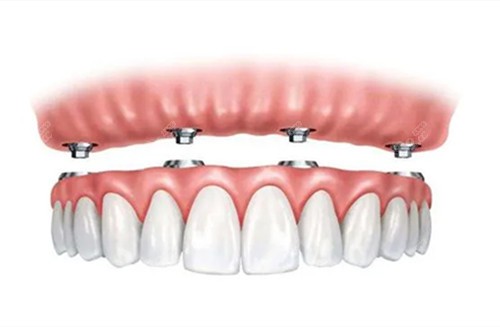 全口種植牙圖示