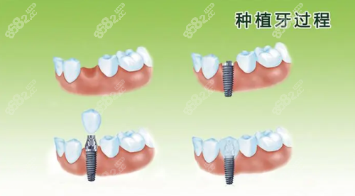 種植牙過程圖片