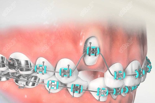 虎牙牙齒矯正過(guò)程 虎牙牙齒矯正過(guò)程